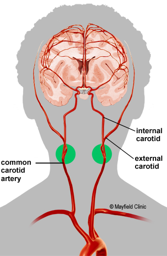 pe-carotidstenosis1.jpg